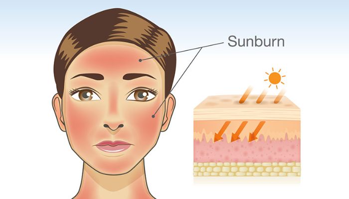 রোদে পোড়া দাগ দূর করার উপায়